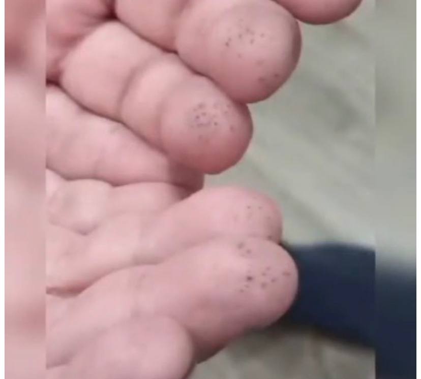 Детские пальчики, исколотые глюкометром Детские пальчики.jpg